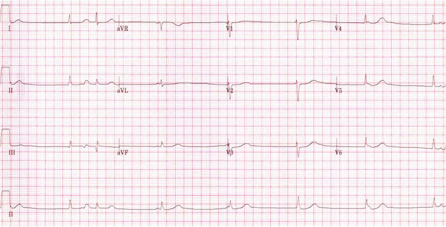 ECG & EP CASES A B P1 P2 P3 P4 P5 P6 P7 1640 1720 1640 1640 1600 1680 280 640 1520 1600 1560 1600 1600 R1 R2 R3 R4 R5 R6 R7 Figure 1-A.