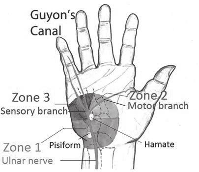 (2) 손, 손목부위상병기초자료 1 척골 ( 자골 ) 신경병터 (Guyon 골관에서의척골신경포착신경병증 ) G56.