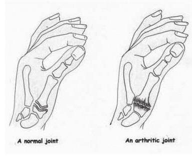 4 제 1 손목손허리관절 ( 수근중수관절 ) 의관절증 M18.0-1 제1수근중수관절의양쪽원발성관절증 Primary arthrosis of first carpometacarpal joints, bilateral 기초정보 관절은뼈와뼈가연결되는부분을의미합니다.