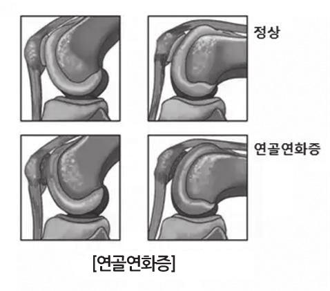 부드럽게움직일수있도록도와줍니다. 대퇴골과그앞에있는슬개골은슬개대퇴관절을이루고 있으며, 이사이에도연골이존재합니다. 질병정보 무릎뼈연골연화증 은무릎뼈연골 ( 물렁뼈 ) 에연화현상 ( 단단해야할연골이부드러워지는것, 약해지는것 ) 이발생하는질환입니다. 슬개대퇴관절내연골조직이약해지거나손상된것을의미합니다. 증상은무릎관절앞부분 ( 슬개골뒤 ) 의둔한통증입니다.