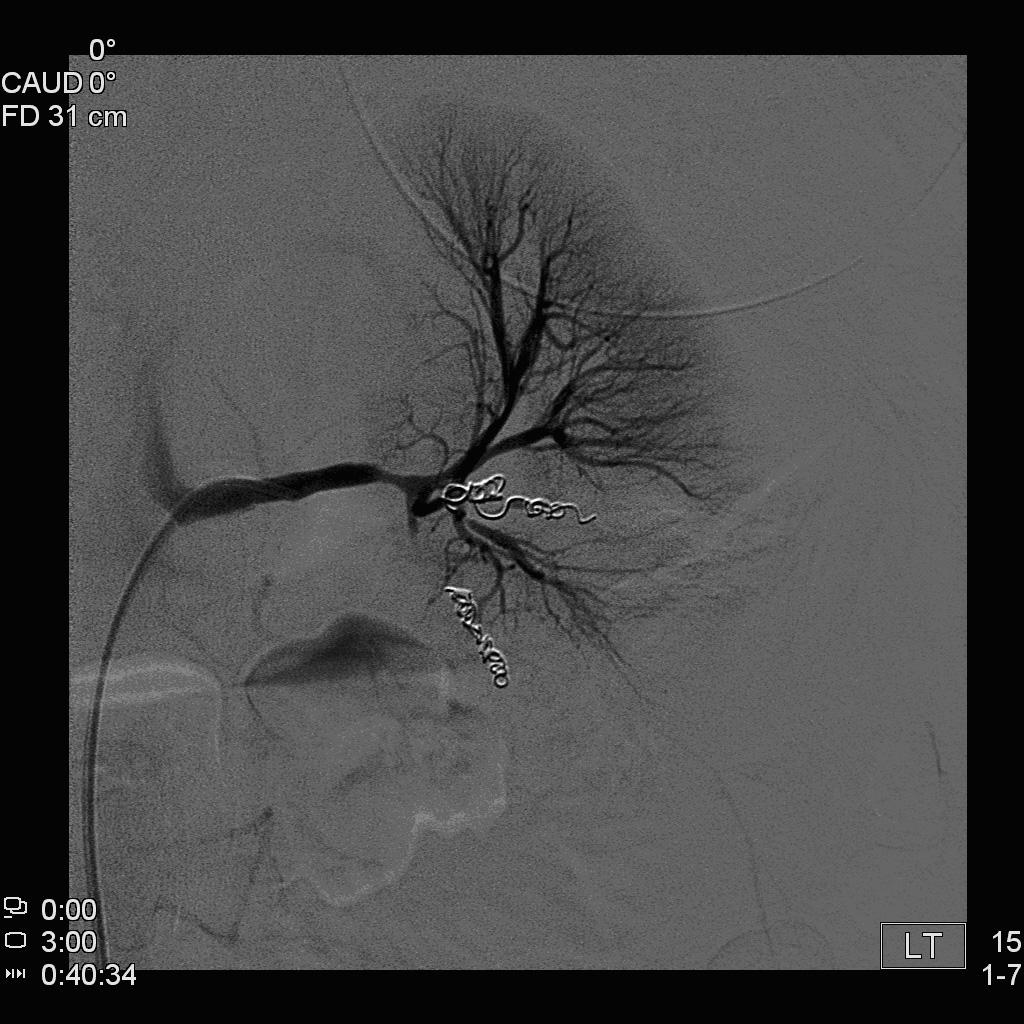62 대한외과중환자연구회지 제1권 제1호 2011년 9월 Fig.1 Abdominal CT scan reveal Fig.2. Angiography shows performing ruptured kidney embolization with metalliccoil at Lt. with active bleeding.