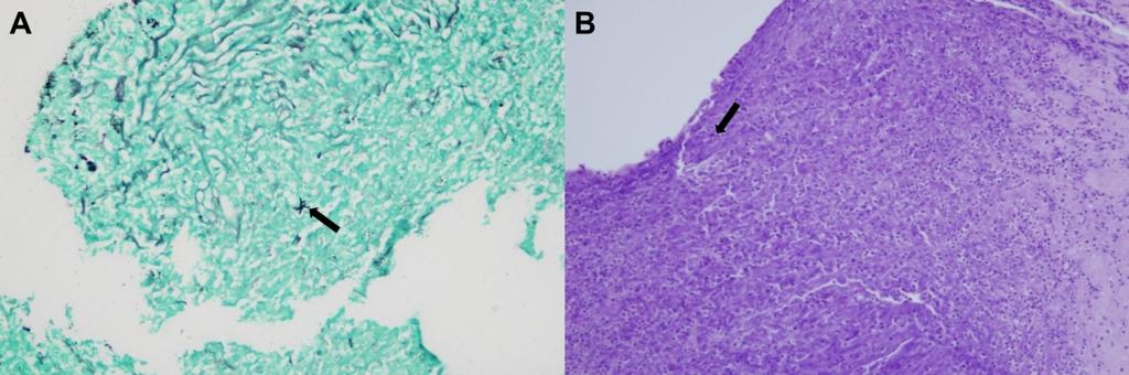 - 검안및콘택트렌즈학회지 2018 년제 17 권제 2 호 - Figure 4. Histopathologic finding of perforated corneal ulcer site. (A) Fungal hyphae (arrow) in the corneal stroma was seen (Gomori-methenamine silver stain, 50).