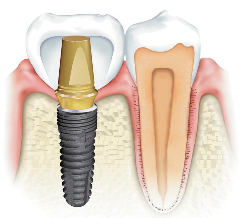 Implant 와자연치아와의차이점 Crown : 치아모형의최종보철물 Abutment : Fixture 와 Crown 을연결해주는지대주 Fixture :