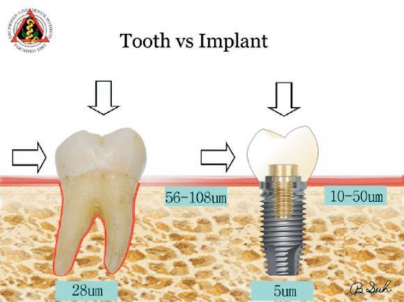 Implant 와자연치아와의차이점 자연치 1 치주인대가치근을둘러싼다.