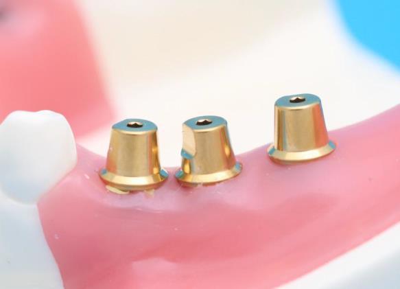 Solid abutment 는 abutment 와 screw 가일체로되어 있는기계적특성에의해 abutment 를분리한후 fixture 에다시연결할경우원래의위치에연결할 수없다.