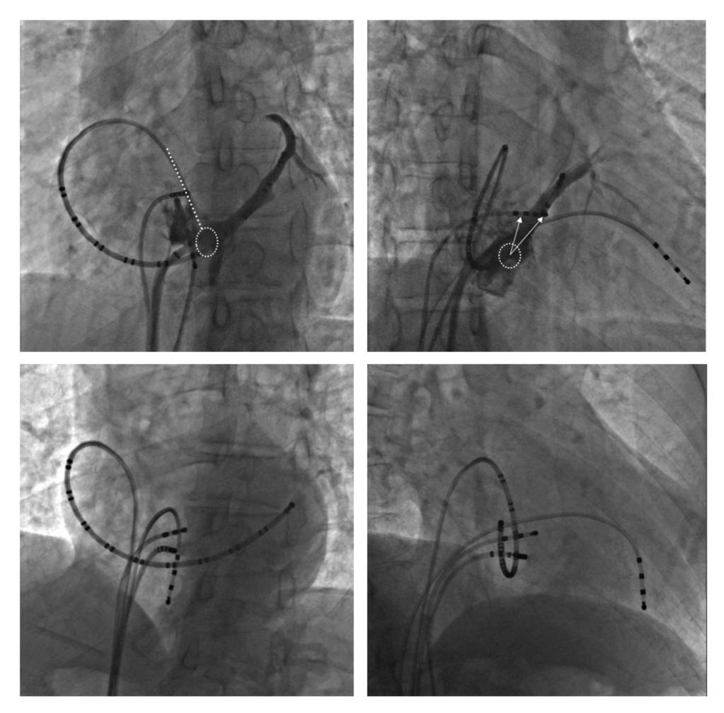 MAIN TOPIC REVIEWS A B VOM VOM C MCV LAO 35 D MCV RAO 35 ABL ABL LAO 35 RAO 35 Figure 2. The relationship between coronary sinus (CS: A and B) and posteroseptum (C and D).