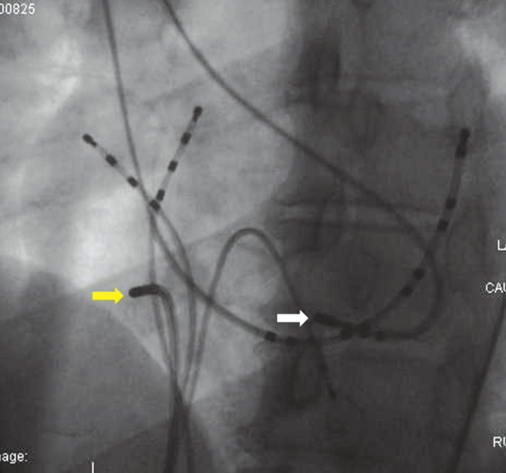 ECG & EP CASES Figure 4. The catheter position of successful ablation site.