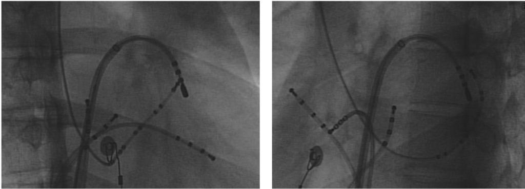 ECG & EP CASES RAO LAO Figure 6. Fluoroscopy showed that the radiofrequency catheter was located at the ateral site of the mitral annulus. References 1. Morady F.
