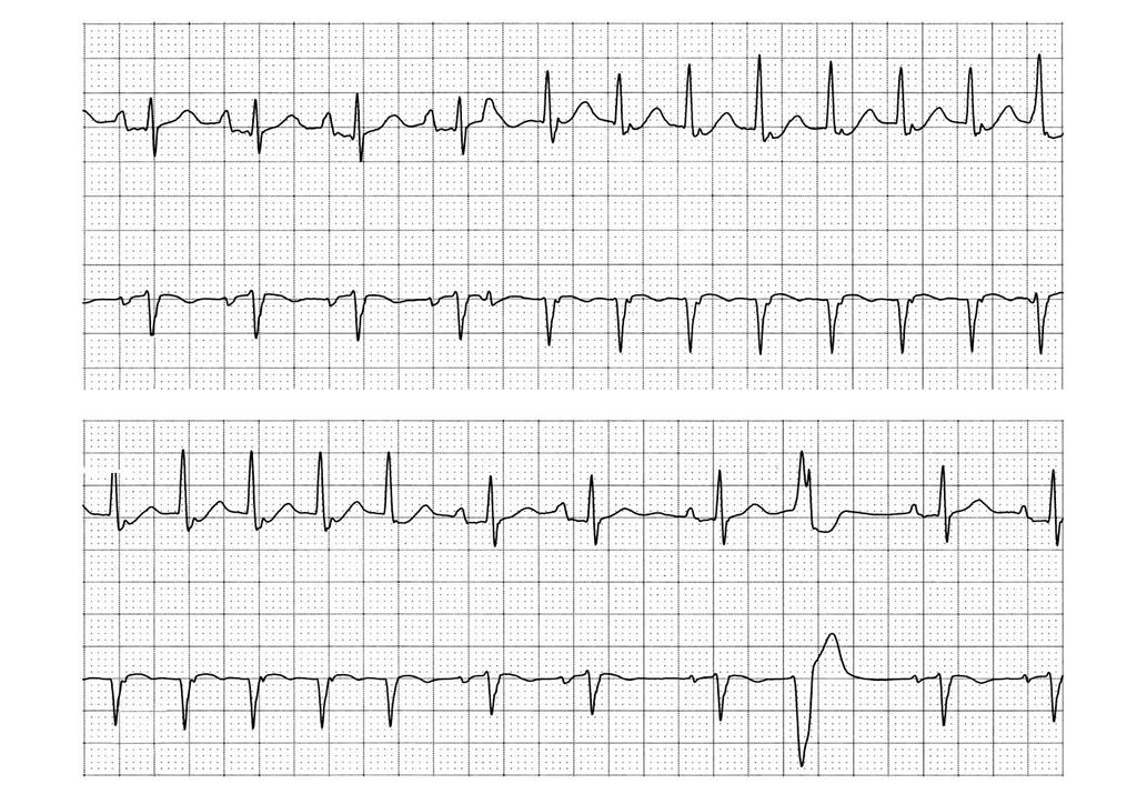 A III ECG & EP CASES V5 B III V5 Figure 1. Paroxysmal AV nodal reentrant tachycardia initiated by an atrial premature beat (A).