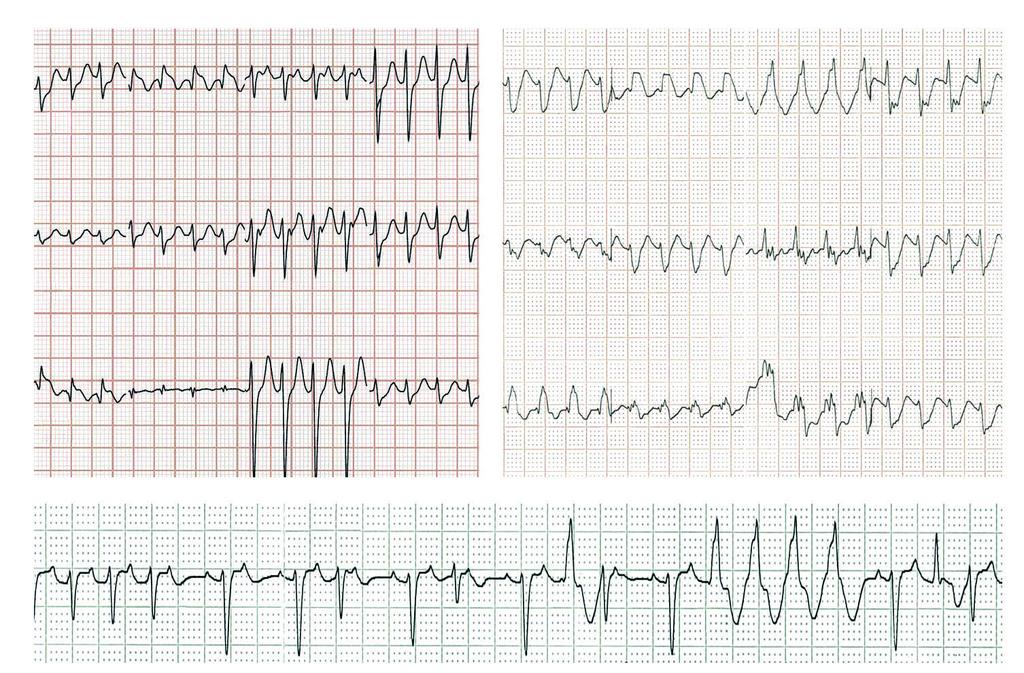 ECG & EP CASES A C I avr V1 V4 V4 avr I II avl V2 V1 V5 avl V5 II III avf V3 V2 V6 avf V6 III V3 B II Figure 2. AV reciprocating tachycardia with a left lateral accessory pathway.