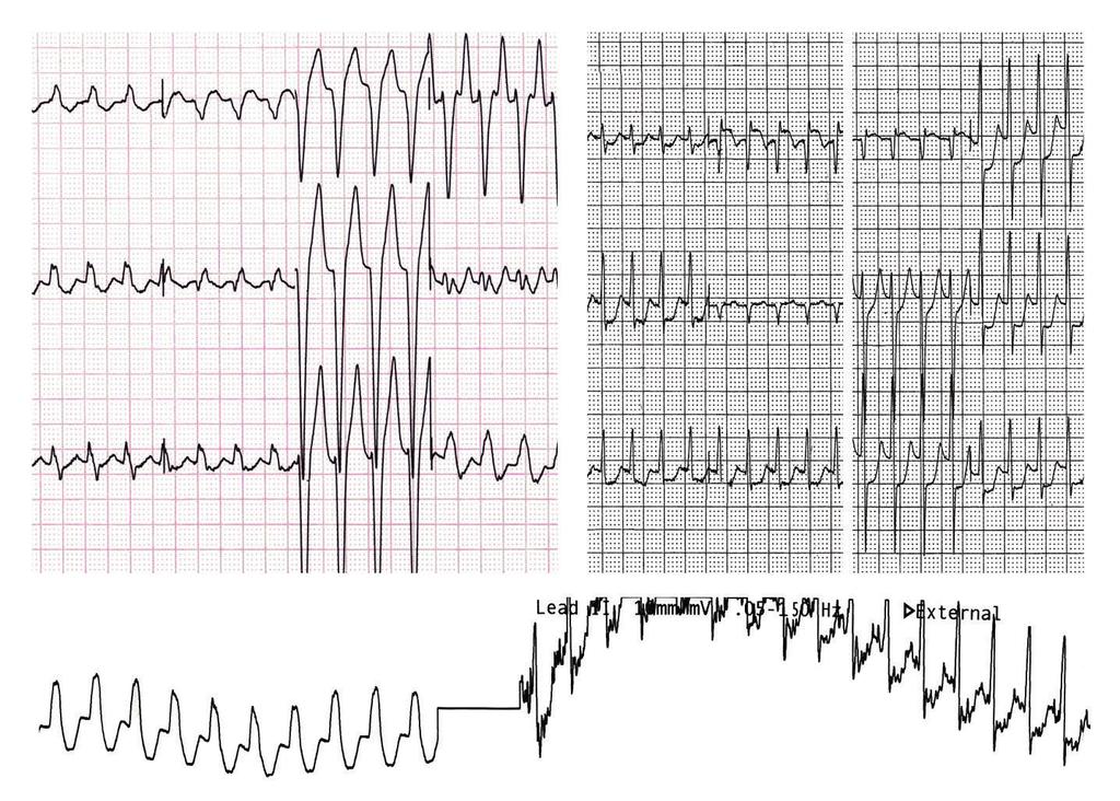 The tachycardia cycle lengths of LBBB and narrow QRS tachycardia were 320 and 280 ms, respectively.