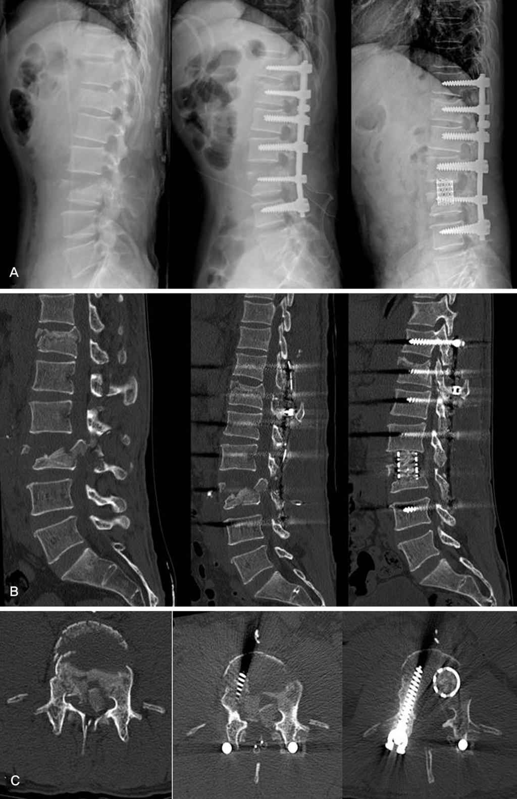 Journal of Korean Society of Spine Surgery Additional Anterior Decompression for Thoracolumbar and Lumbar Fractures Fig. 2.