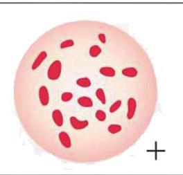 40 회차 04 그림은어떤사람의혈액형판정결과를나타낸것이다. 항 A 혈청 항 B 혈청 항 A 혈청에는응집소 a 가있고, 항 B 혈청에는응집소 b 가있다.
