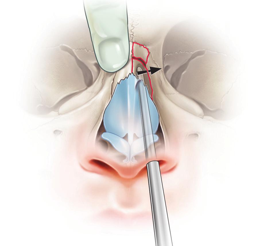 비과 부밑에위치한전사골신경 (anterior ethmoidal nerve), 중비갑개뒤쪽에위치한접형구개신경 (sphenopalatine nerve), 비중격, 그리고비강저에시행한다.