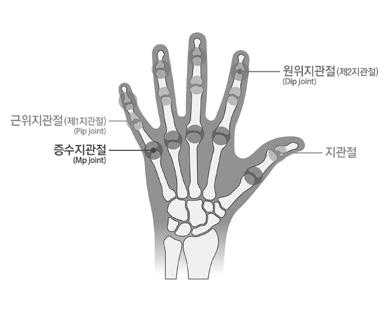 이하이거나중수지관절의굴신운동영역이정상운동영역의 1/2 이하인경우를말한다. 8) 한손가락에장해가생기고다른손가락에장해가발생한경우, 지급률은각각적용하여합산한다. 9) 손가락의관절기능장해평가는손가락관절의관절운동범위제한등으로평가한다.