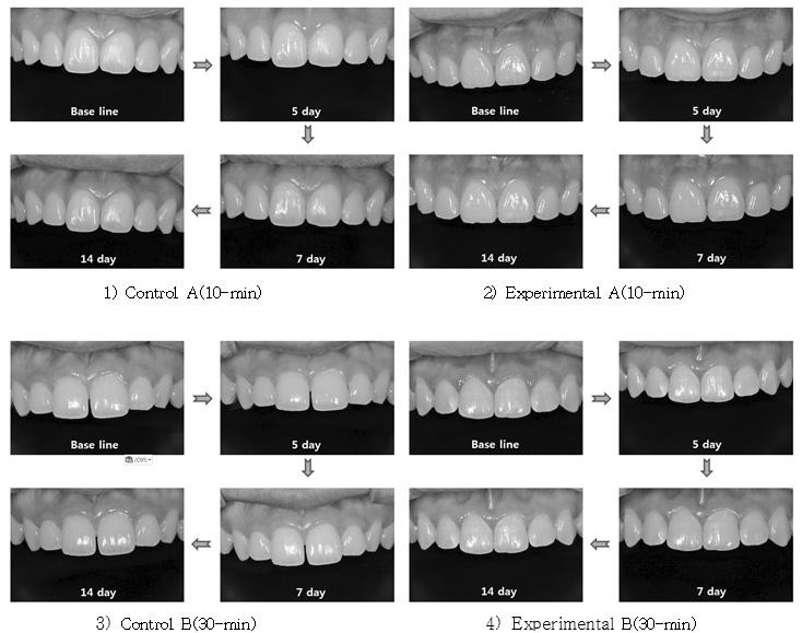 2016 년 10 월 29 일 10:00-19:00 Fig. 1. Color changes of Groups by bleaching periods on maxillary anterior teeth 4.