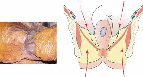 단직장암이이근처에있을때는박리를피해야한다 (Fig. 2). Abdominal approach (Total Mesorectal Excision) Rectum Mesorectum Tapered mesorectum near the level of levator ani muscle Perineal Dissection (SAPD) Fig. 2. Mesorectum was tapered down near the level of levator ani muscle.
