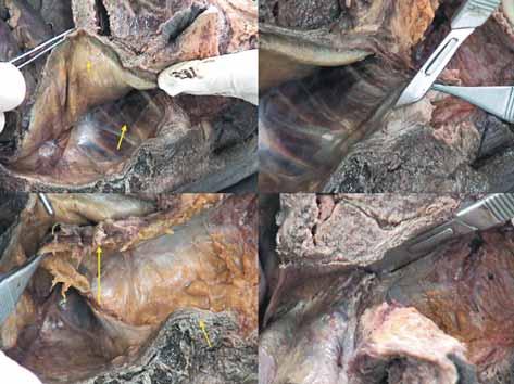 김남규 : 원위부직장암의복회음절제술을위한임상해부학적지식및술기 263 Mesorectum and fascia Levator ani m. Levator ani m. coccyx Fig. 5.