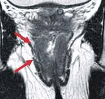 Levator ani muscle was also clearly seen at coronal image, which was hanging down to the anal sphincter muscle. Fig. 8.