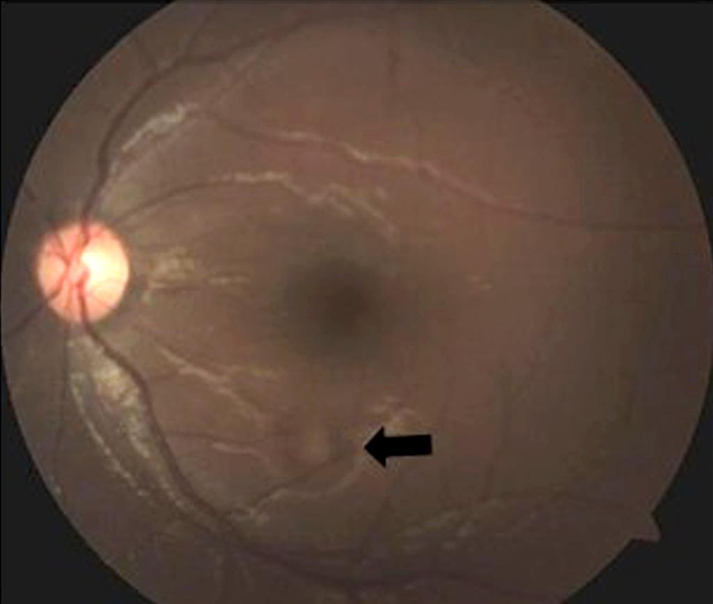 Newly onset retinal astrocytic hamartoma (black arrow) is found on
