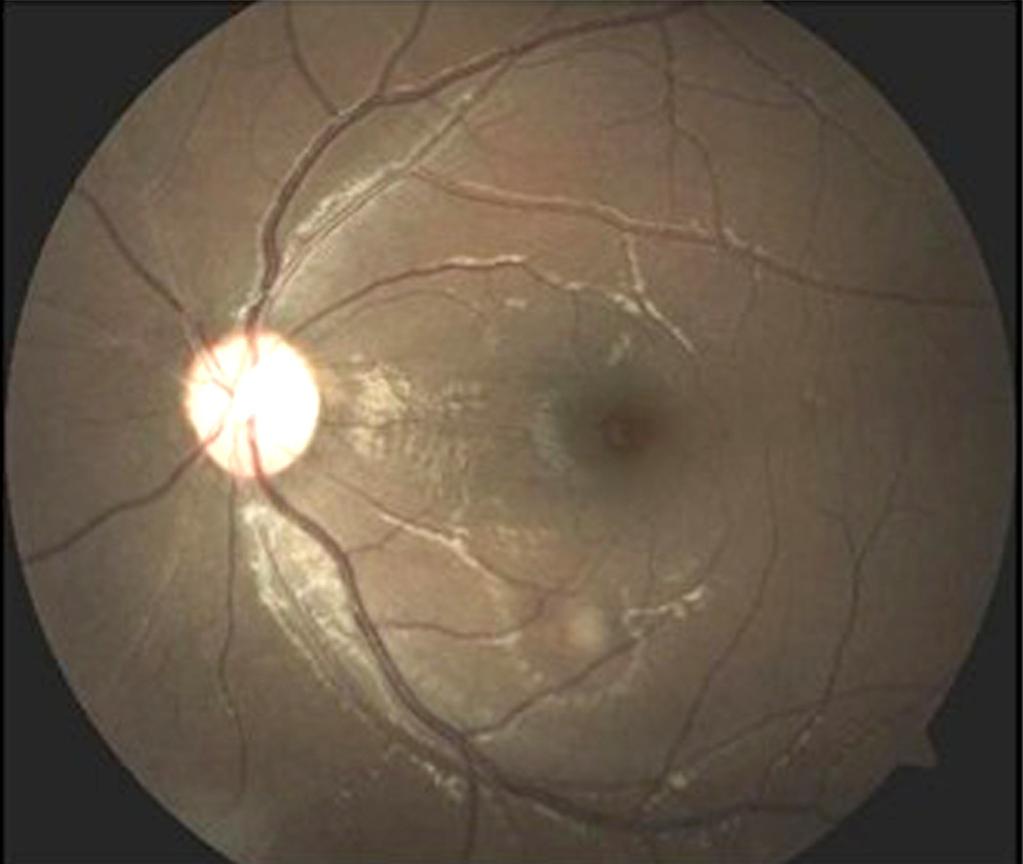 (C) Three years later, fundus photograph shows development of retinal