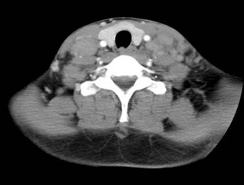 Neck CT and chest CT () show multiple enlarged homogenous lymph nodes.