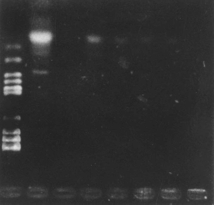 상악암에서 HPV와 EBV의 검출 (Fig. 1), HPV16아형을 검출하기위하여 oligoprimer을 and 4). 또한 상악암조직이 아닌 염증성 용종의 대조군에서 이용한 PCR을 시행한 결과 HPV consensus primer에 양 는 HPV와 EBV가 모두 음성반응을 보였다.