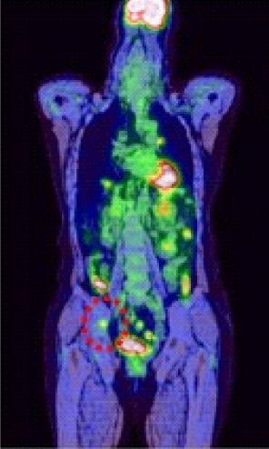 대한간학회지제 14 권제 4 호 2008 A B1 B2 C Figure 3. Imaging findings obtained at 22-26 months after surgical resection of liver tumor.