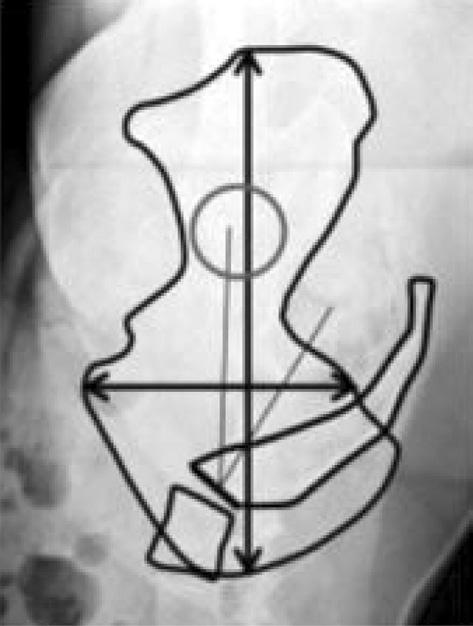 15 Spino-Pelvic Parameters in Adult Spinal Deformities 반의회전에따라 PI는변화가없으나골반이후방회전하여 PT가증가하면천추경사각이감소하고, 골반이전방회전하여 PT가감소하면그각도만큼천추경사각이증가하게된다.