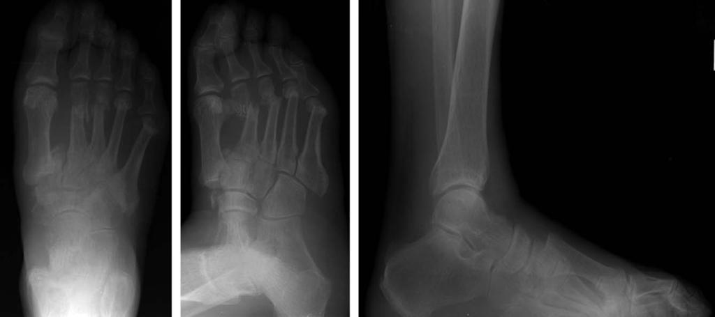 중족관절 Charcot 관절병증에대한한국형 CROW 보조기를이용한치료 / 71 A B C Fig. 1. A 67 year old male patient visited to our hospital due to the prolonged swelling and mild pain of right foot.