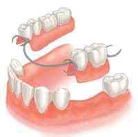 치아보철치료비 Ⅱ 특별약관 용어의정의 영구치 : 유치 ( 젖니 ) 가빠진후나는자연치아를말합니다. 영구치발거 : 치아가뿌리까지손상되어어떠한치료를하더라도치아의전부또는일부라도보존할수없다고판단되어영구치를발거한경우를발합니다.