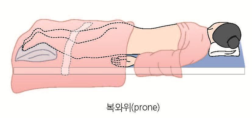 3. 수술중처치 수술체위 복와위 prone position 엎드린체위 척추수술등 얼굴, 흉곽,