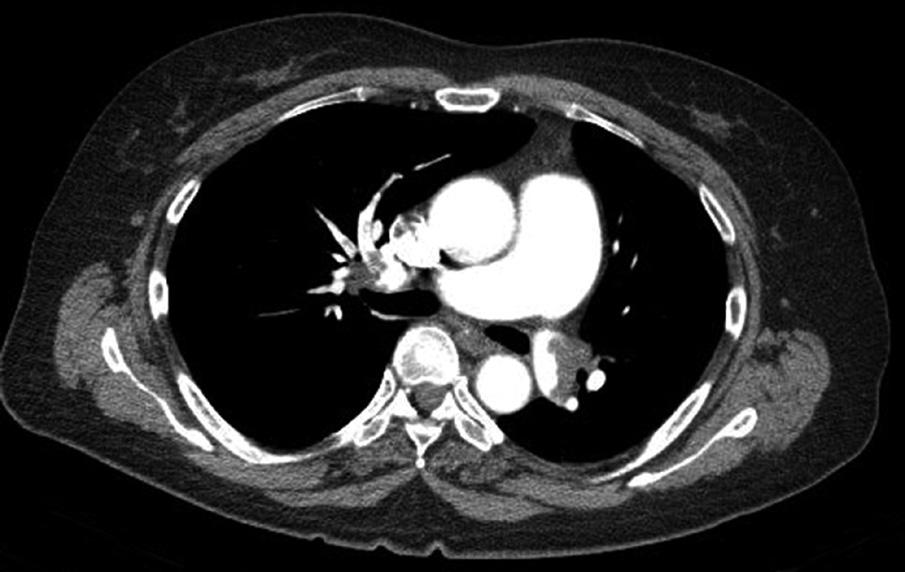 perfusion is relatively well preserved on pulmonary perfusion image (C). A B C Fig. 3.