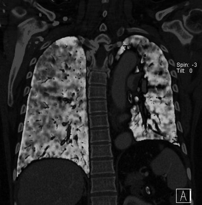prominent low attenuation on lung window setting image (B) and perfusion defect areas on pulmonary perfusion image (C). 으로평가하였을때 DS에서만유의확률이 0.