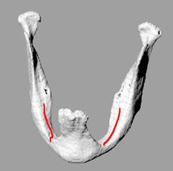 Examples: Mandible Reconstruction this