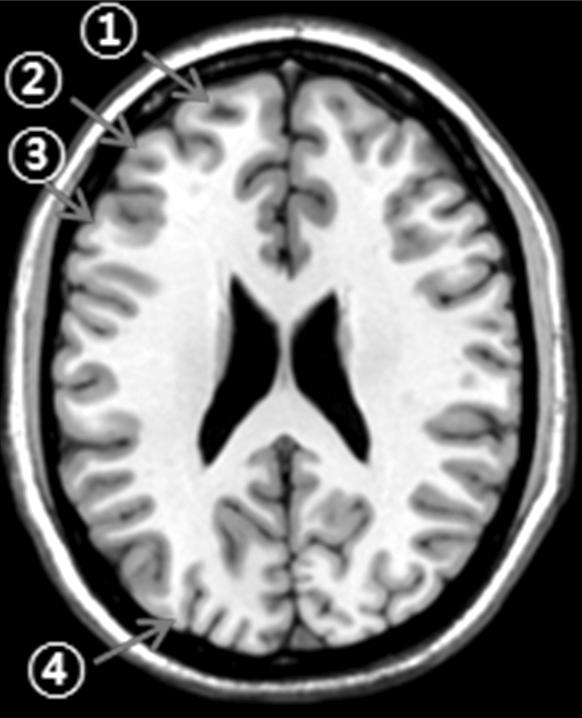 Inferior parietal lobule, 8. Internal capsule anterior limb, 9. Basal ganglia, 10. Insular cortex, 11. Internal capsule-posterior limb, 12. Hippocampus, 13.