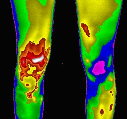 극저온현상보임 knee Normal image