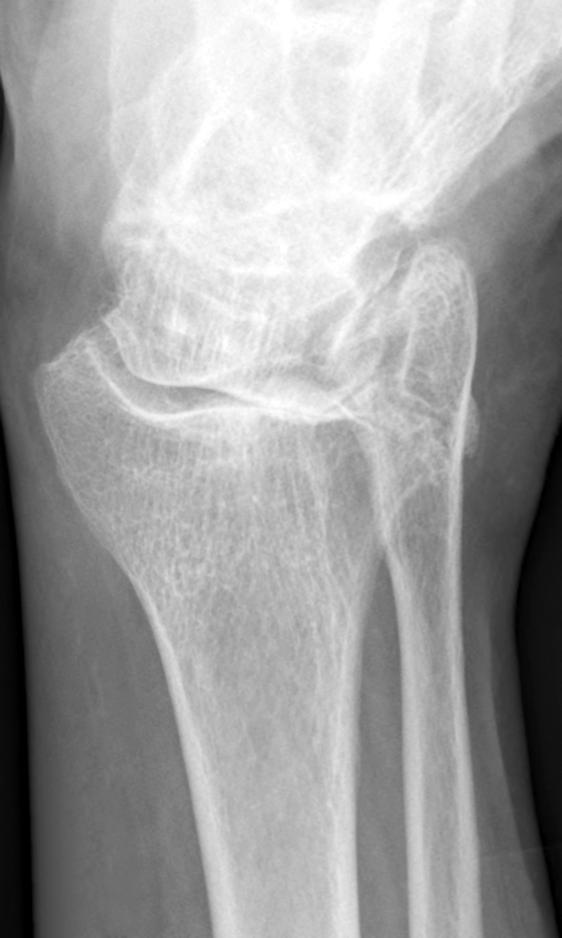 11 Bi O Jeong, et al. Severe Ankle OA: Treatment with TAA 경우가 많다. 특히, 류마티스 관절염 환자에서 비교적 흔한 것으로 2. 감염 알려져 있다.