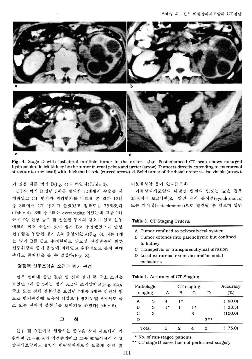 조혜영외 : 신우이행상피세포앙의 CT 진단 c Fig. 4. Stage D with ipsilateral multiple tumor in the ureter. a.b.c. Postenhanced CT scan shows enlarged hydronephrotic left kidney by the tumor in renal pelvis and ureter (arrow).