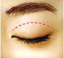 관련의학지식 - 쌍꺼풀수술 2) l 시술정보 l 위눈꺼풀수술은대부분아래눈꺼풀수술과는별도로진행. 위눈꺼풀수술은눈꺼풀의자연적인주름에눈꺼풀을따라절개하고원치않는피부, 지방, 근육을제거함. 쌍꺼풀을만들어고정하고, 절개부위를봉합. 피부절제가필요없는경우절개부위를최소화하는부분절개나매몰법을사용함.