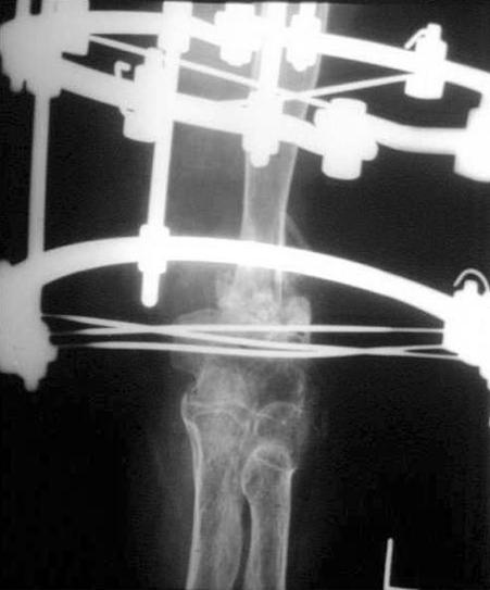 (B) Postoperative radiograph shows interposition of the distal fragment to