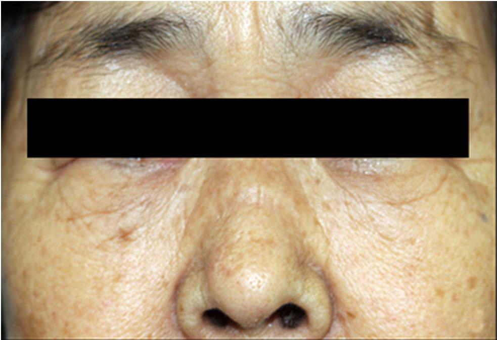 - 대한안과학회지 2017 년제 58 권제 10 호 - A B C D Figure 1. Case 7. This 68-year-old woman presented with epiphora. She had a history of sinusitis and periorbital inflammation.