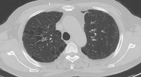 7 병력 과거력 없음 현재력 고혈압(2003 년) 1번대상자의흉부엑스선상 RLL의 pulmonary fibrosis, CT상 Honeycomb cysts, reticular densities in BLL -> UIP(Usual interstitial pneumonia)