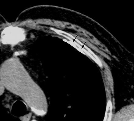 CT소견은흉막반의분포확인에도 움을주며, [ 그림 8] 상에서단순흉부사진상에보이지않는전측과척추 간흉막반도윈도상에서조직음영상을변화시키면볼수있음을알수 이있다. 다.