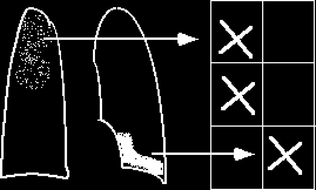 소음영은 2가지모양분류와 1가지 의크기구분이있다. 모양은원형 (round) 과비정형(irregular) 으로 구분되고직경의크기에따라각각 3 가지의크기로분류한다.