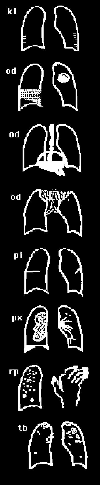 326 지하철역사근로자의석면노출에대한건강영향평가 부록 325 ef - effusion em - definite emphysema es - egg shell calcification fr - fractured rib(s) hi - enlargement of hilar or mediastinal lymph nodes ho - honeycomb lung id