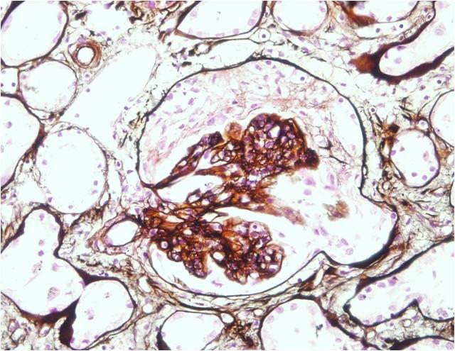 (D) Interstitial inflammation with many lymphocytes and some eosinophils (black arrow) was noted by light microscopy (hematoxylin and