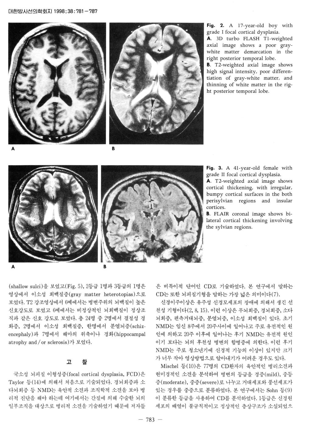 대한방시선의학회지 1998; 38: 781-787 Fig. 2. A 17-year-old boy with grade 1 focal cortical dysplasia. A. 3D turbo FLASH Tl-weighted axial image shows a poor graywhite matter demarcation in the right posterior temporal lobe.