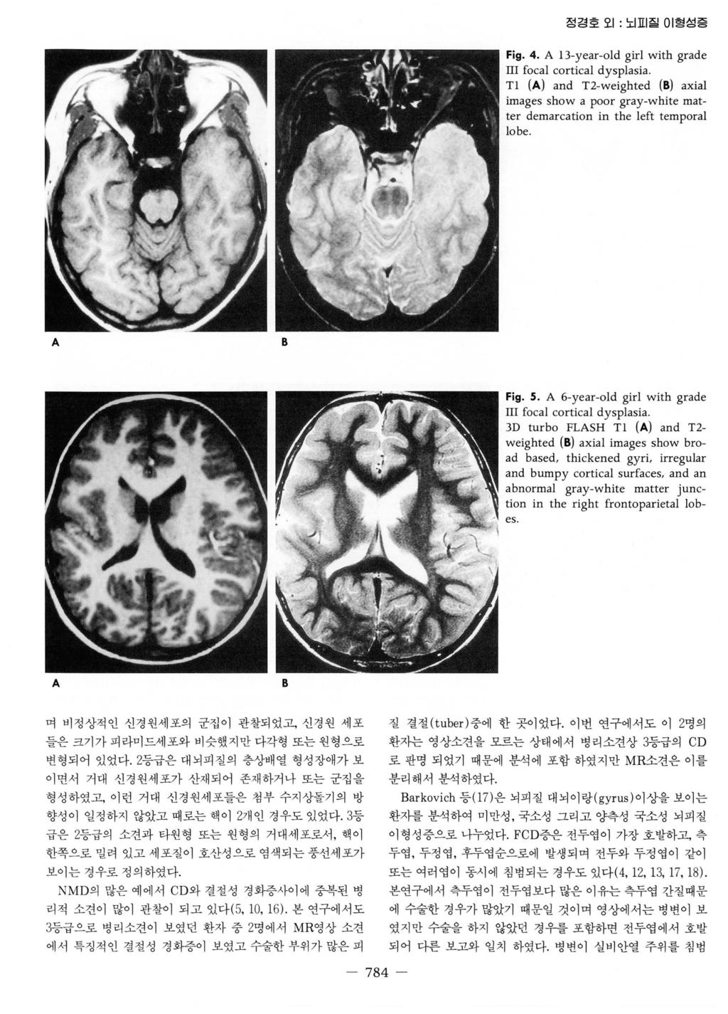 정경호오 1: 노 표 질이형성증 Fig. 4. A 13-year- 이 d girl with grade m focal cortical dysplasia. Tl (A) and T2-weighted (8) axial images show a poor gray-white matter demarcation in the left temporal lobe.