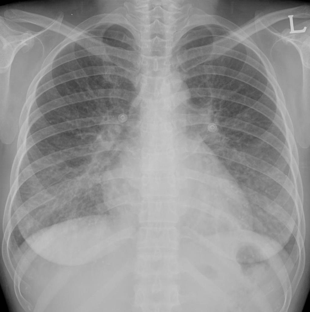 Chest X-ray finding of ADHF Cardiomegaly Pleural effusion